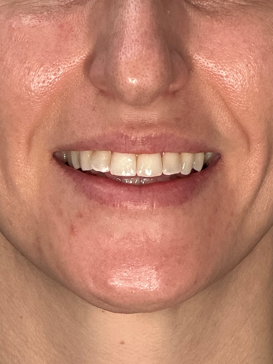 Lip Enhancement Gallery Before & After
