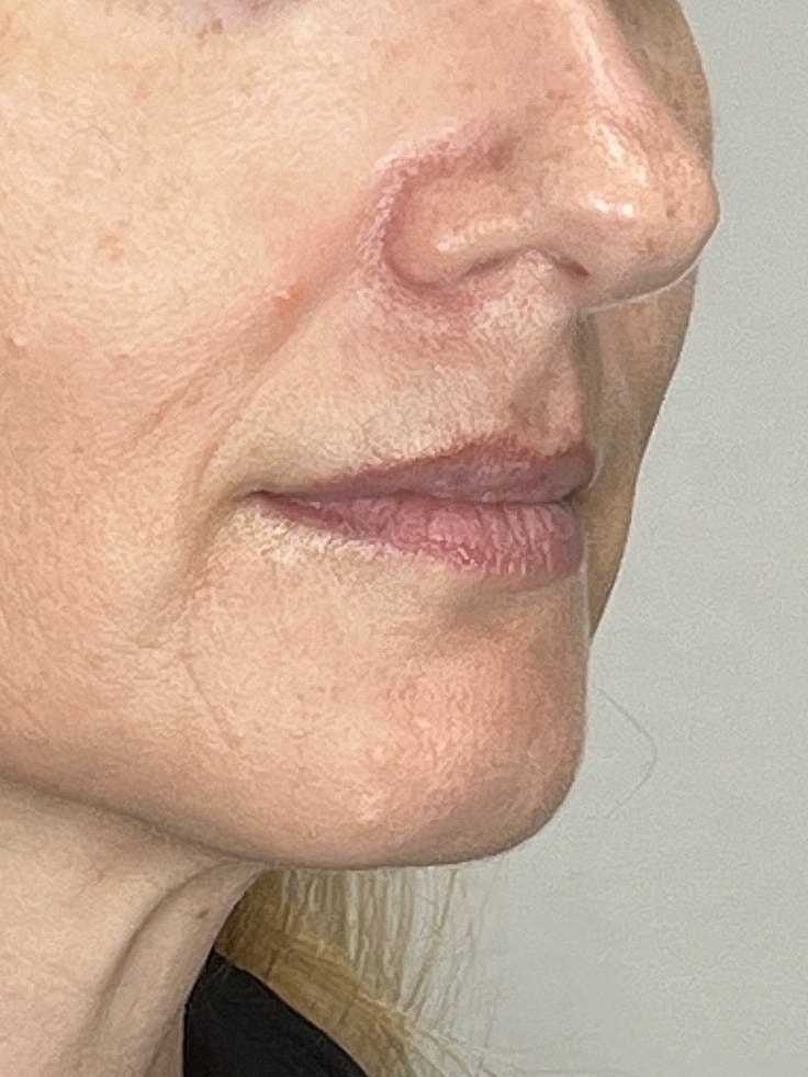 Lip Enhancement Gallery Before & After
