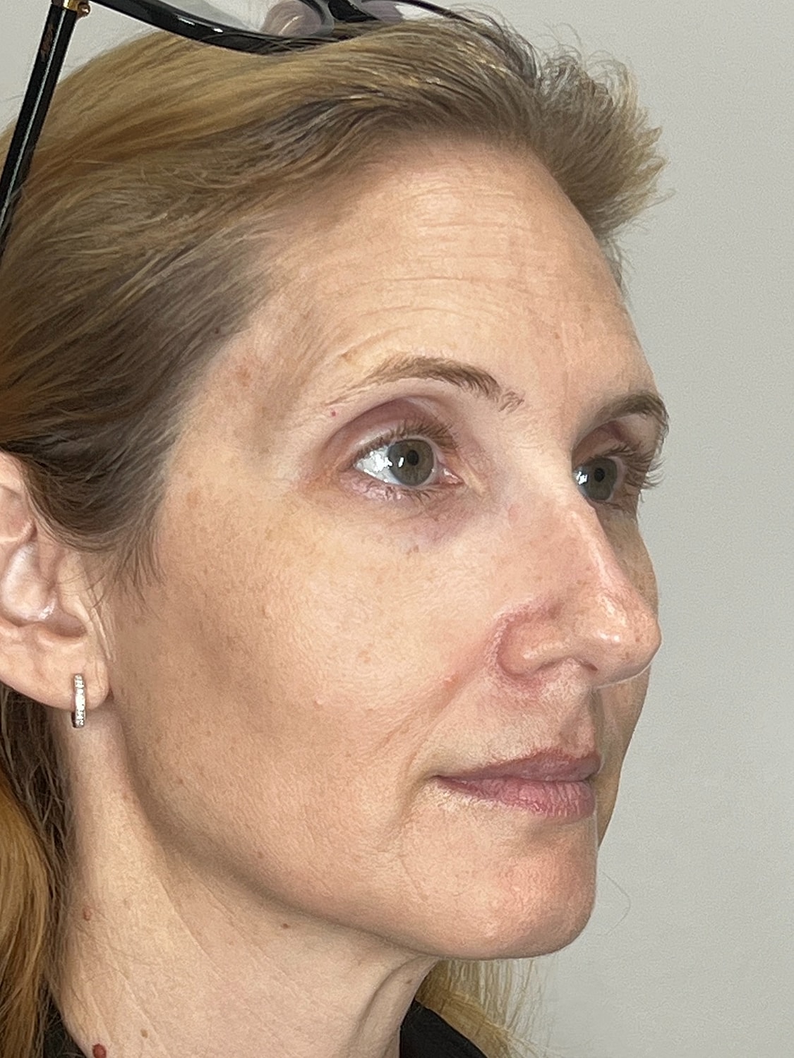 Lip Enhancement Gallery Before & After