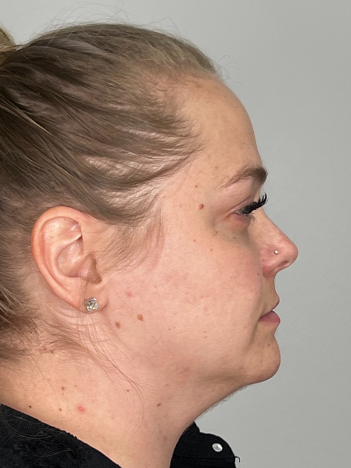 Lip Enhancement Gallery Before & After