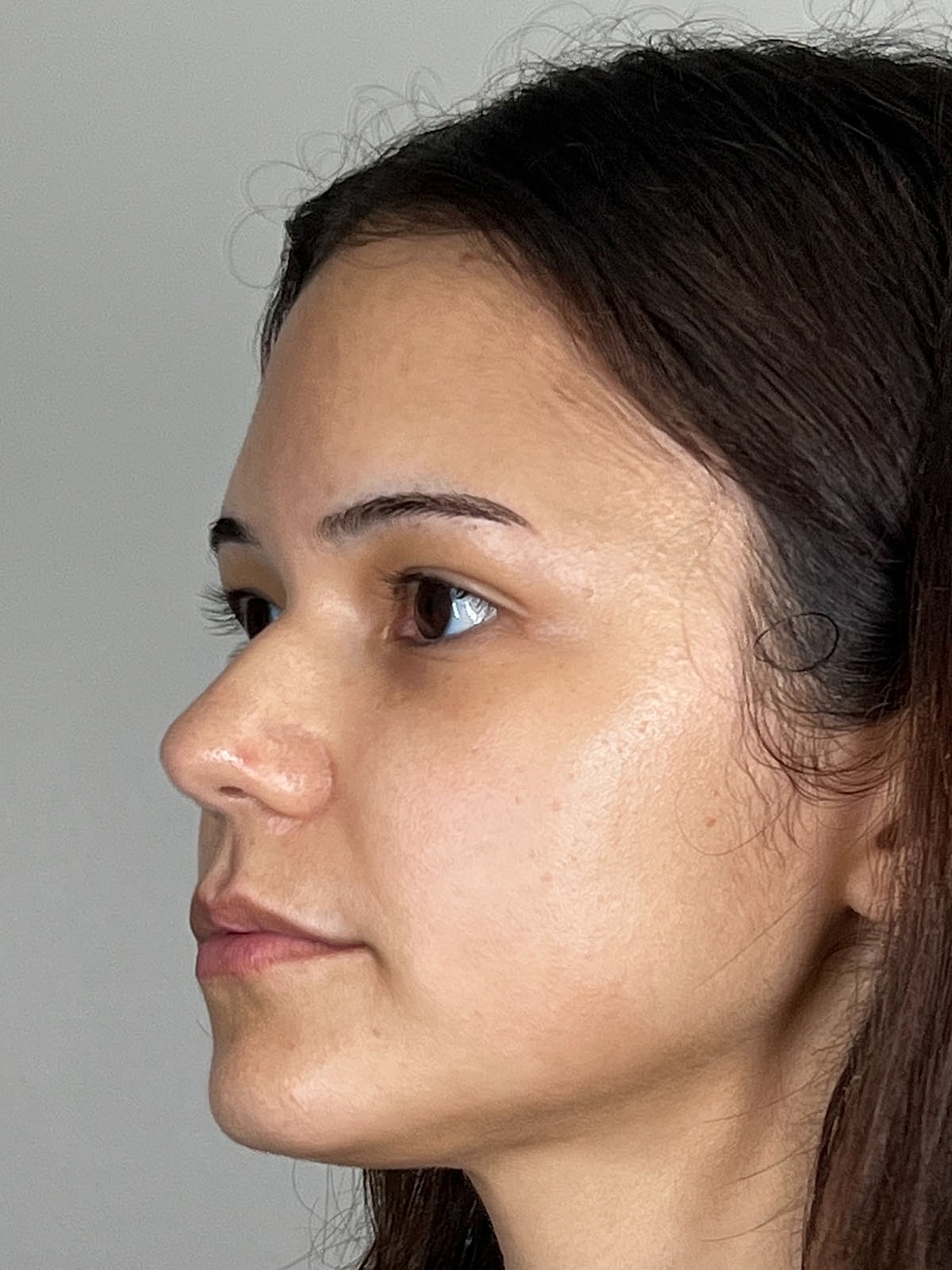 Lip Enhancement Gallery Before & After