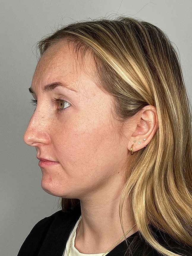 Lip Enhancement Gallery Before & After