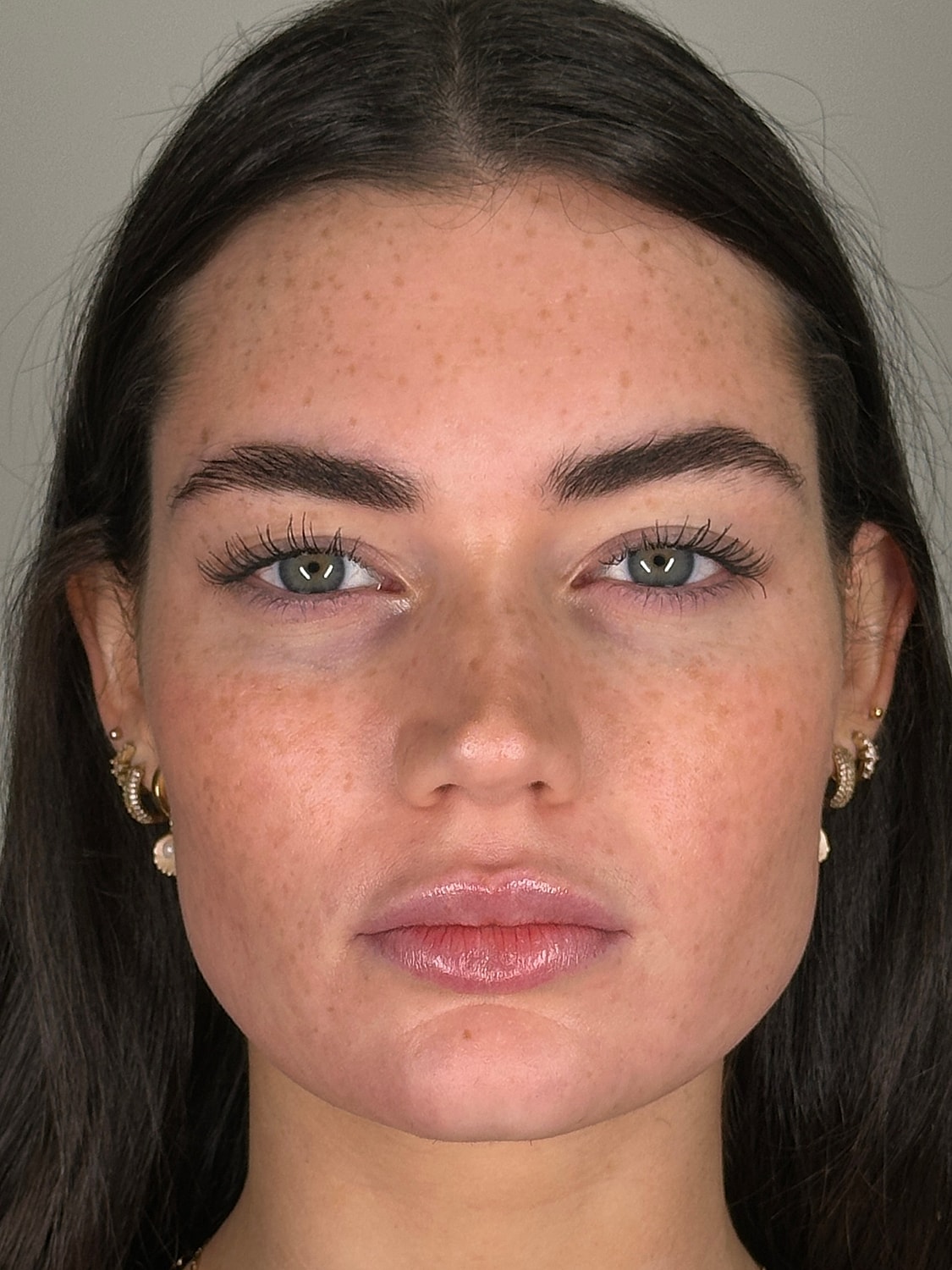Juvederm Before & After