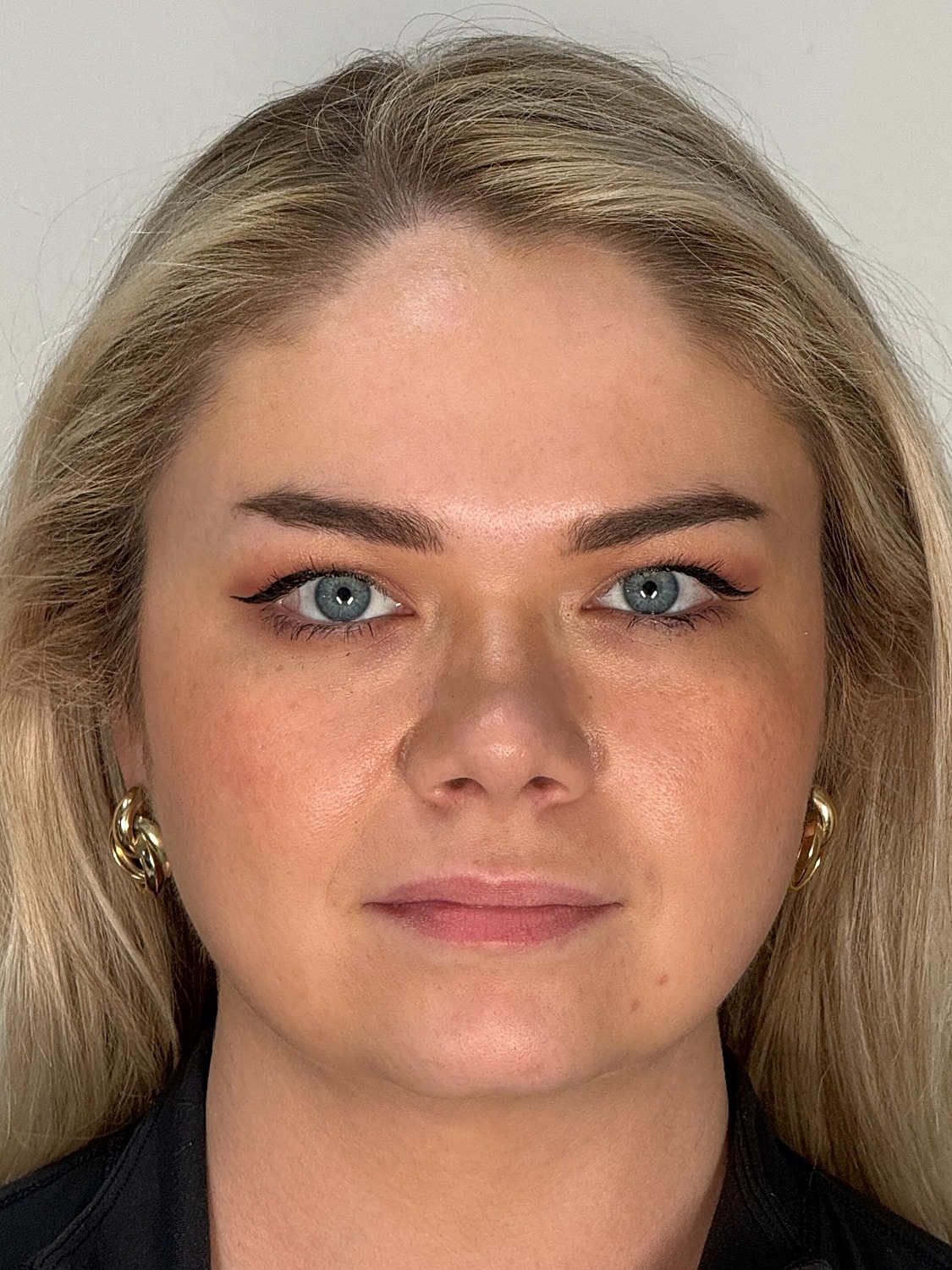 Lip Enhancement Gallery Before & After