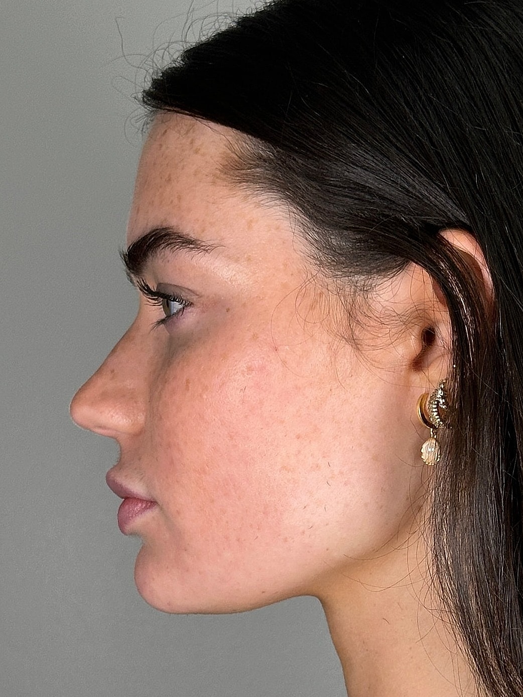 Juvederm Before & After