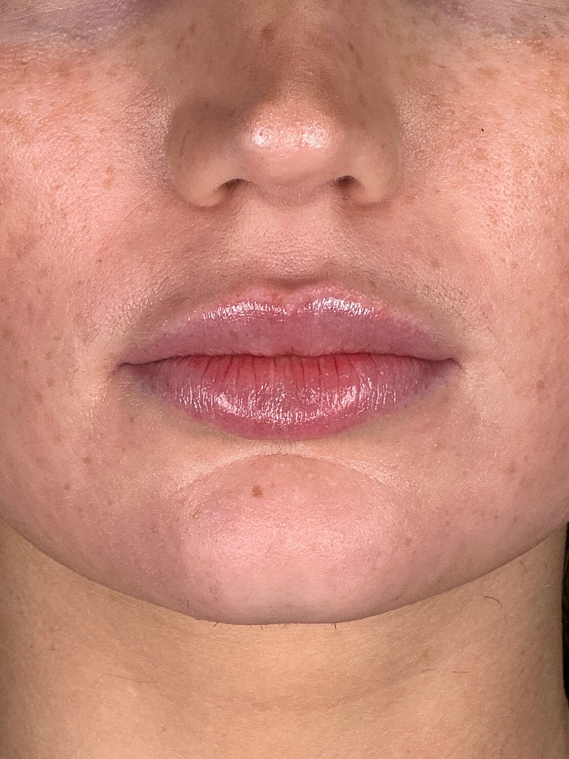 Juvederm Before & After