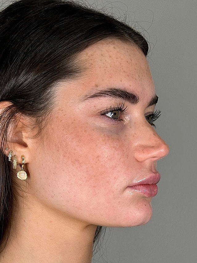 Juvederm Before & After