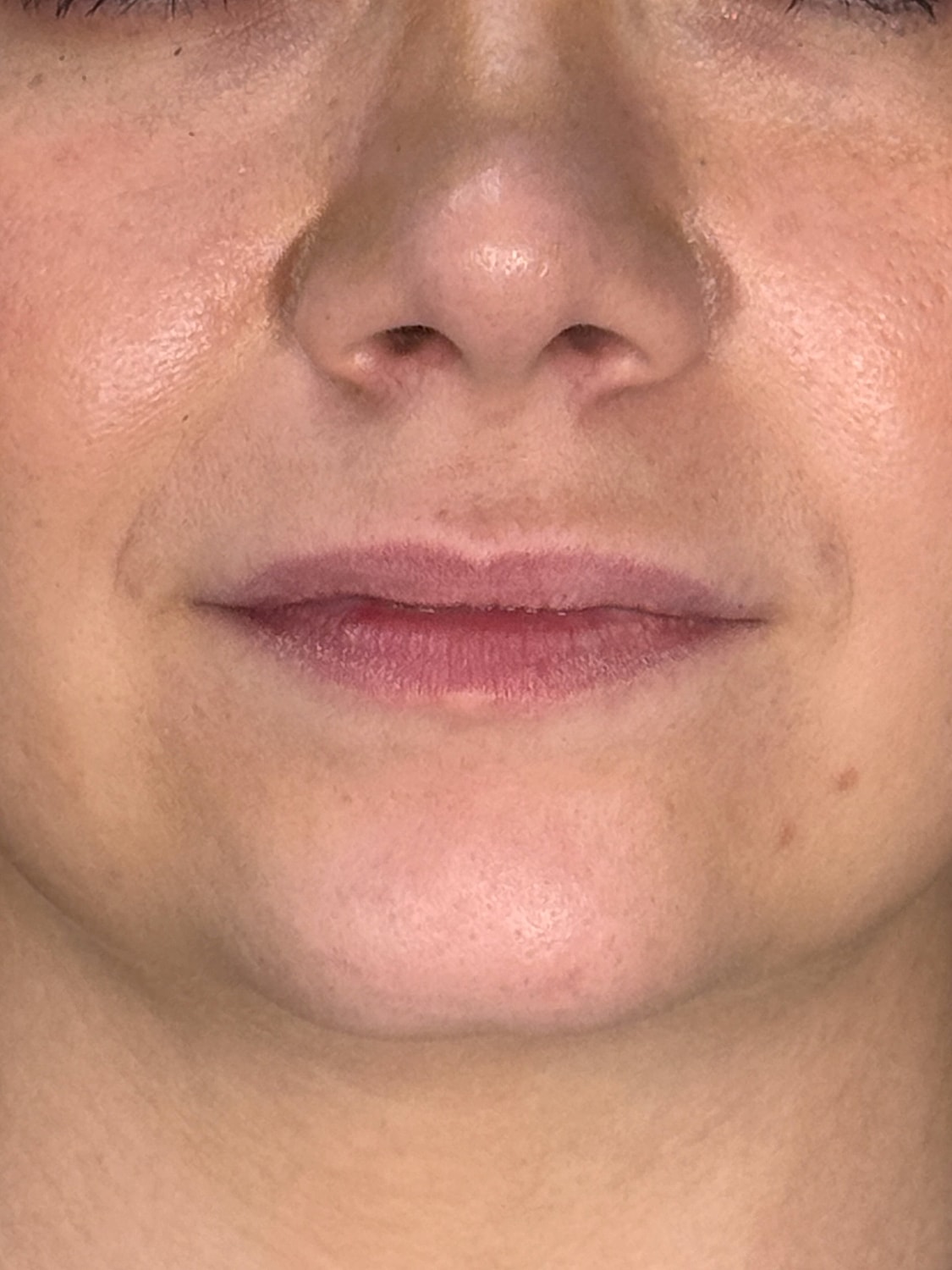 Lip Enhancement Gallery Before & After