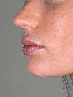Juvederm Before & After