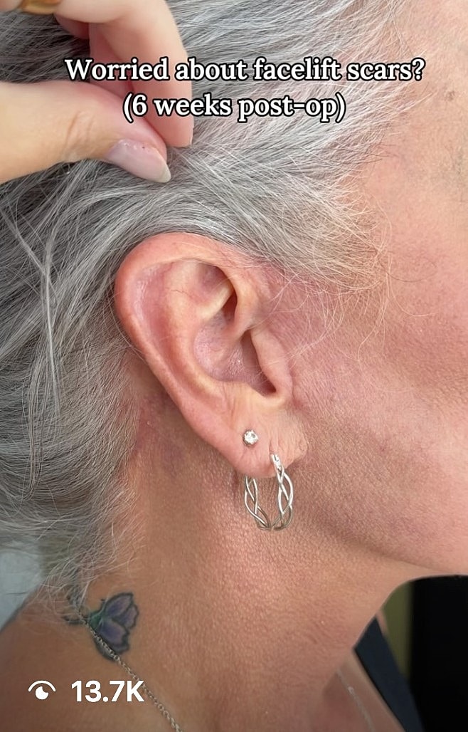Facelift scars six weeks post-operation close-up.